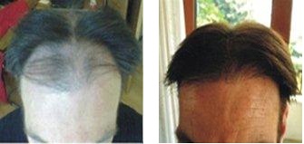 ian-before-after